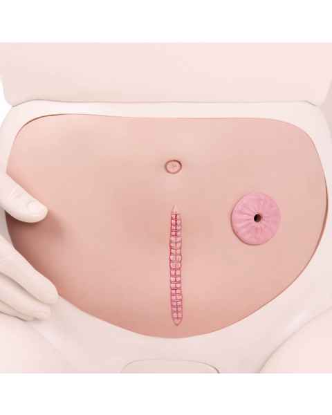 Abdominal Wall with Staple Suture