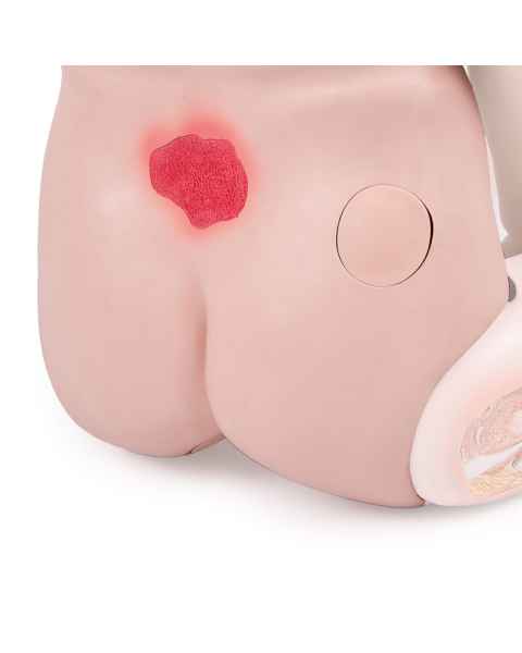 3B Scientific 1018811 Lower Trunk with Decubitus