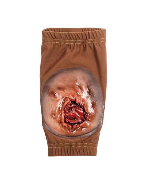STOPS Medical 1025870 Brachial Wound Sleeve - Dark Skin Tone