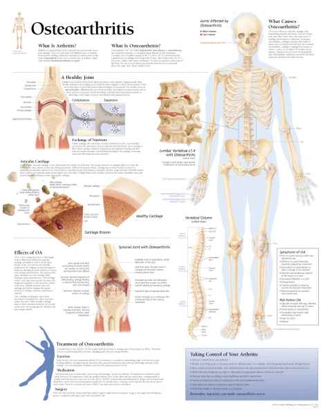 Osteoarthritis Chart