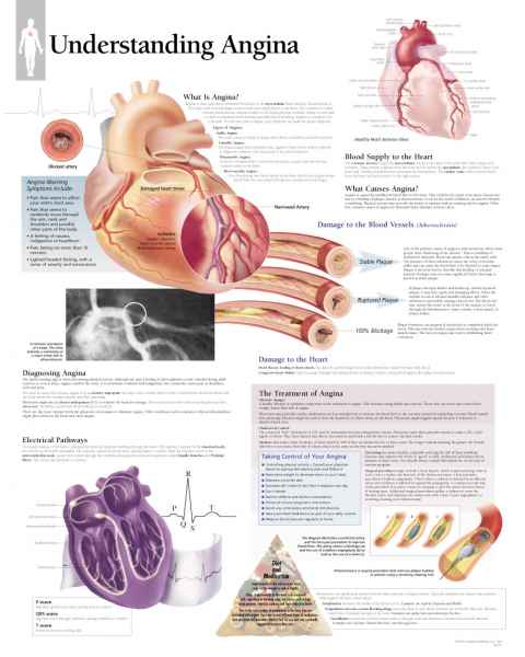 Understanding Angina Chart