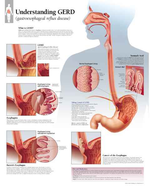 Understanding GERD (Gastroesophageal Reflux Disease) Chart