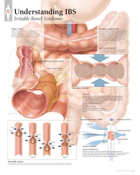 Understanding IBS (Irritable Bowel Syndrome) Chart