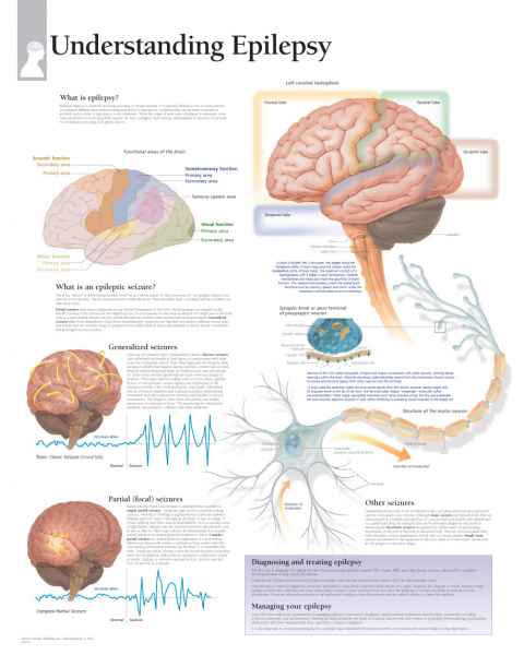 Understanding Epilepsy Chart