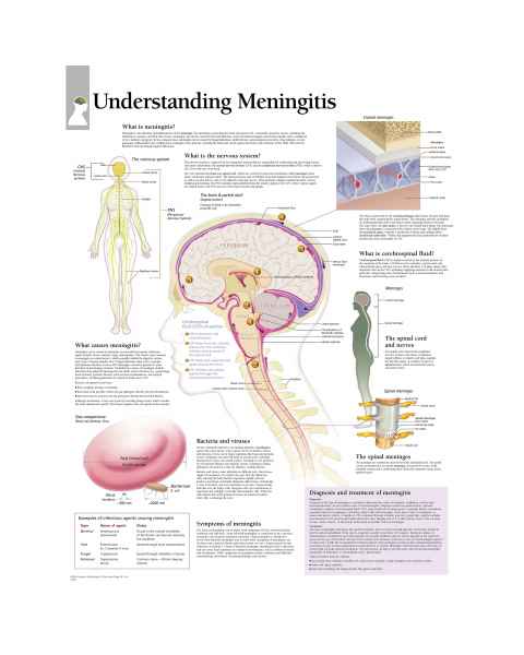 Scientific Publishing Understanding Meningitis Chart