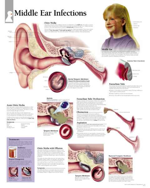 Middle Ear Infections Chart