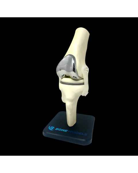 Bone Models&trade; 390301 Bone Shade Knee Model with Generic Implant, Front View