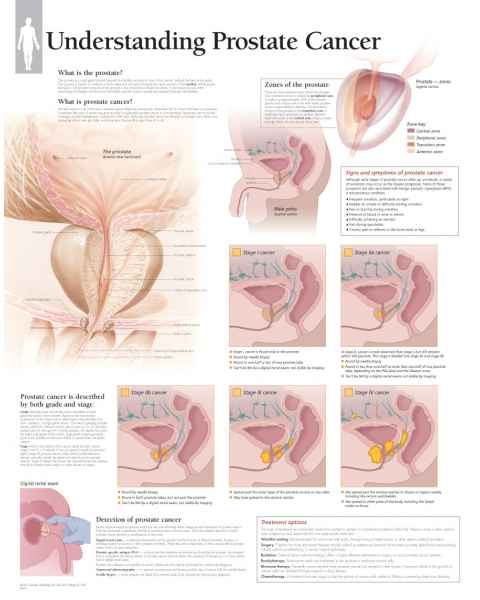 Understanding Prostate Cancer Chart