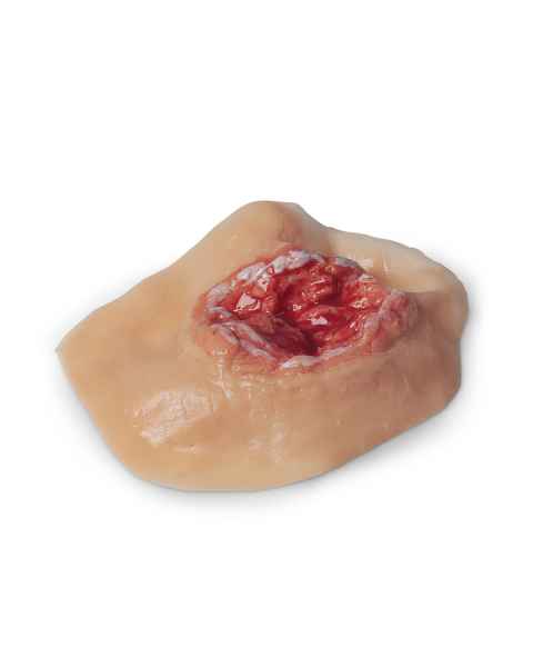 Life/form Moulage Wound - Burn, Electrical, Palm Simulator