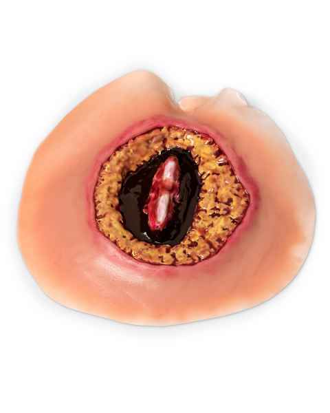 Life/form Moulage Wound - Bed Sore, 4th Stage, 70 mm Simulator