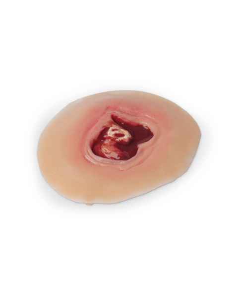Life/form Moulage Wound - Diabetic Ulcer, 20 mm Simulator