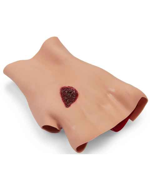Life/form Moulage Wound - Phosphorus Burn - Hand Simulator