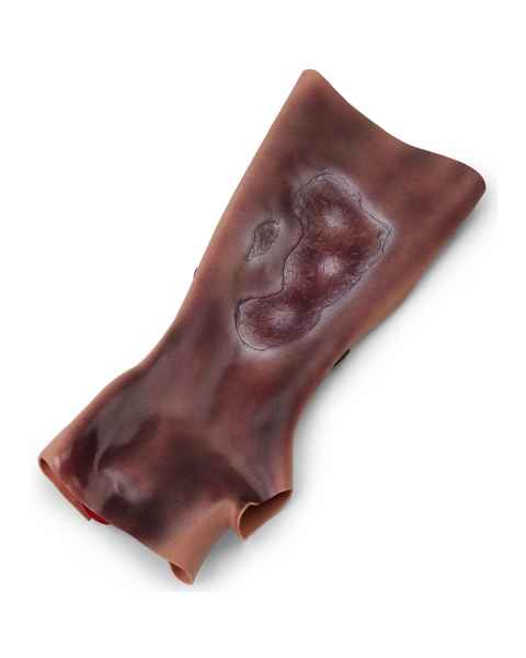 Life/form Moulage Wound - Burn - Forearm - 2nd/3rd Degre Simulator