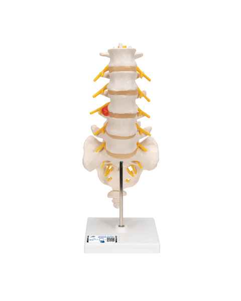 3B Scientific A76/5 Human Lumbar Spinal Column Model with Dorso-Lateral Prolapsed Intervertebral Disc - 3B Smart Anatomy