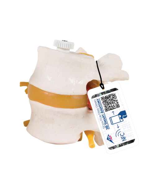 3B Scientific A76-9 Two Lumbar Vertebrae with Prolapsed Disc Flexibly Mounted - 3B Smart Anatomy