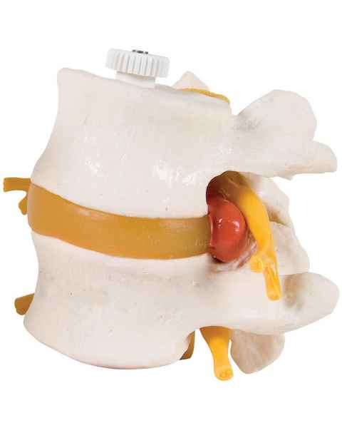 2 Lumbar Vertebrae With Prolapsed Disc Flexibly Mounted