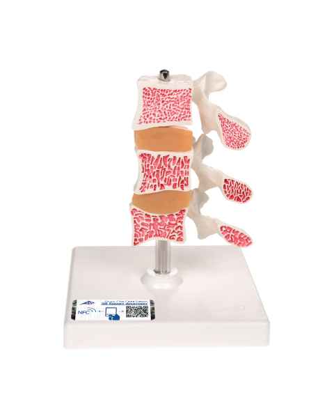 3B Scientific A78 Deluxe Osteoporosis Model (3 Vertebrae) - 3B Smart Anatomy