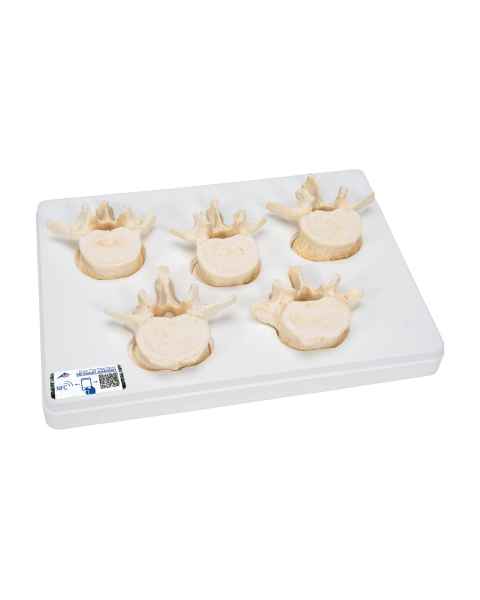 Set of 5 BONElike Lumbar Vertebrae - 3B Smart Anatomy