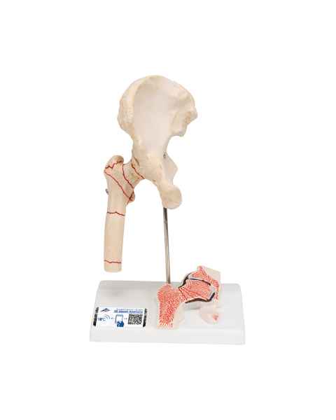Femoral Fracture and Hip Osteoarthritis Model