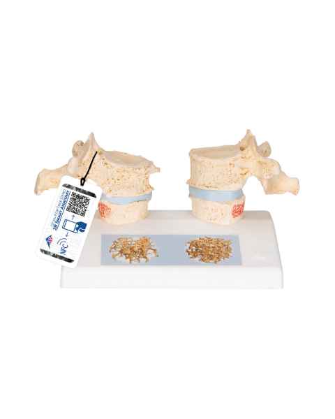 3B Scientific A95 Osteoporosis Model - 3B Smart Anatomy