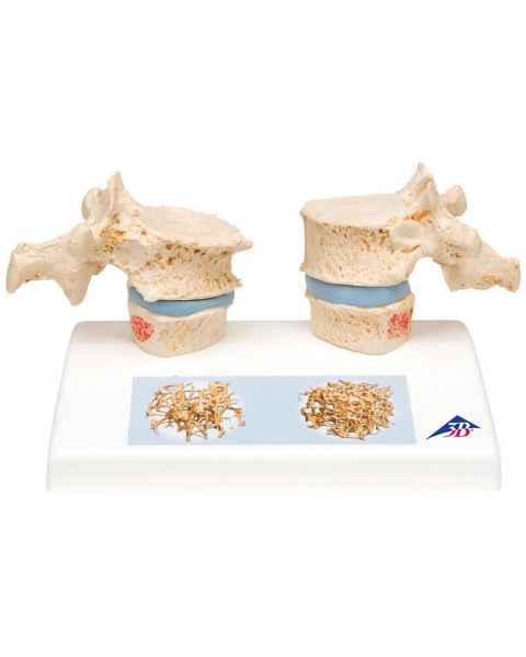 Osteoporosis Model