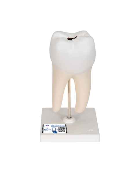 Lower Twin-Root Molar Showing Cavities 2-Part