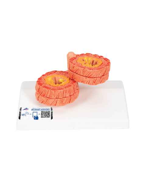 3B Scientific G50/1 COPD Bronchial Tissue Model - 3B Smart Anatomy