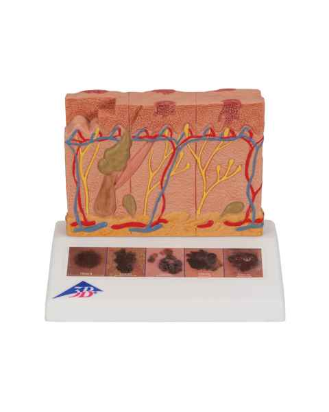 3B Scientific J15 Skin Cancer Model - Enlarged 8 Times, 3B Smart Anatomy