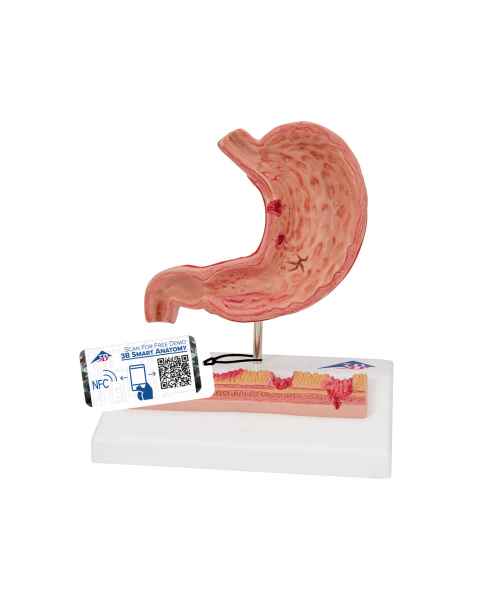 3B Scientific K17 Stomach Model with Ulcers