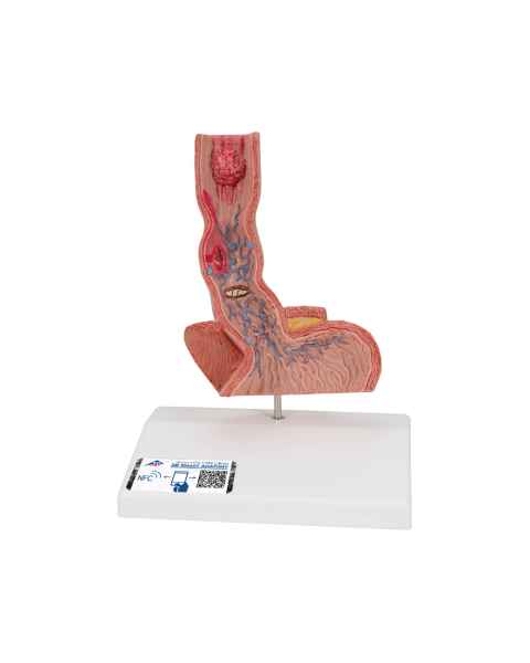 3B Scientific K18 Diseases of the Esophagus Model