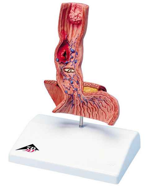 Diseases of the Esophagus Model