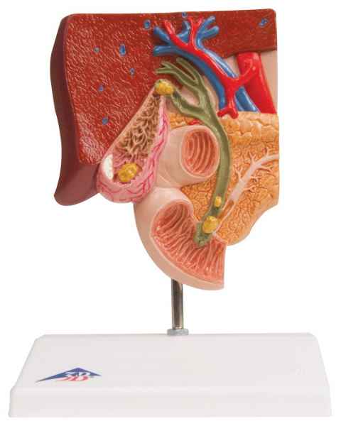 Gallstone Model