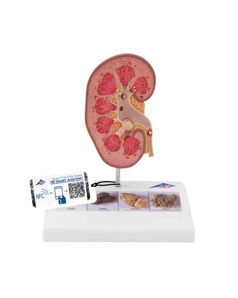 Kidney Stone Model