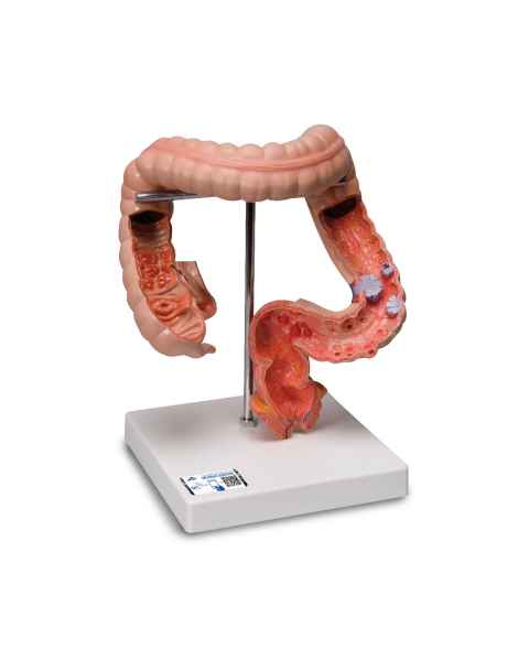 3B Scientific K55 Intestinal Diseases Model