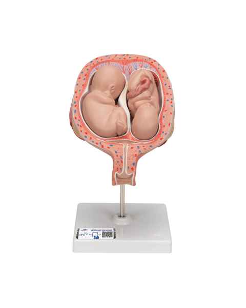 5th Month Twin Fetus Model - Normal Position
