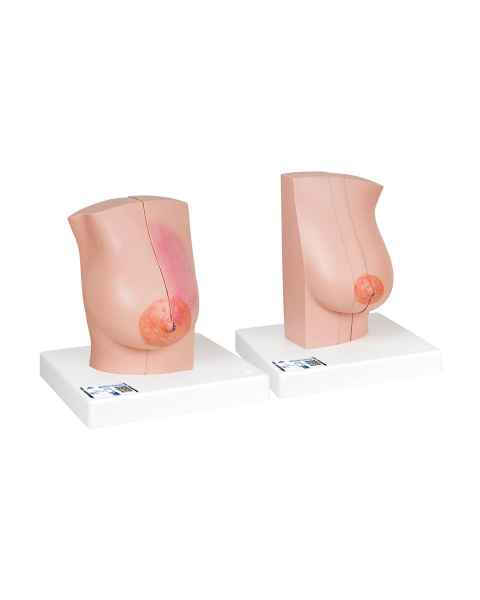 3B Scientific L56 Model of the Female Breast with Healthy and Unhealthy Tissue