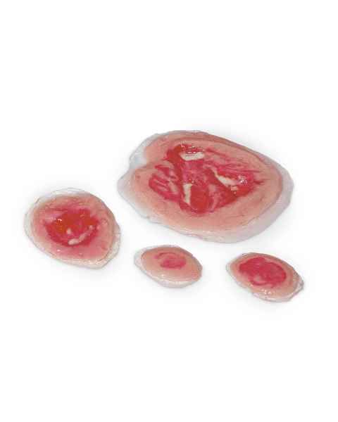 Life/form Moulage Wound - Pressure Ulcers Simulator - Set of 4