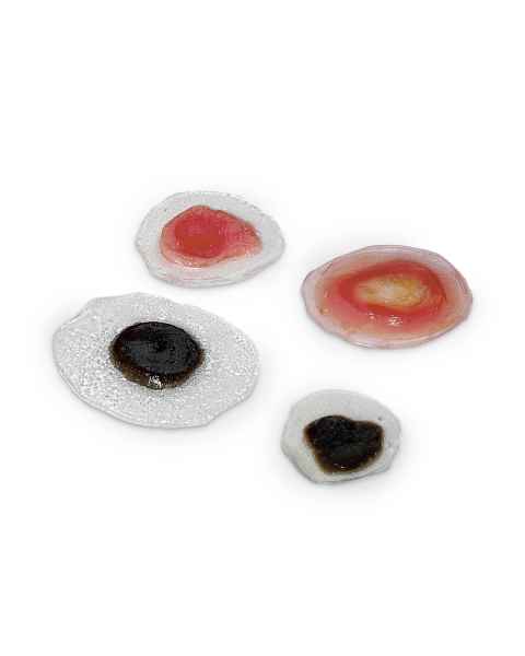 Life/form Moulage Wound - Moles/Skin Cancer Simulator - Set of 4