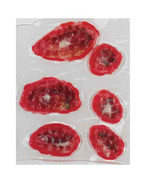 Life/form Venous Stasis Ulcer Simulator