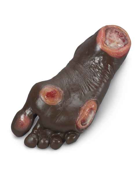 Life/form Elderly Pressure Ulcer Foot - Dark