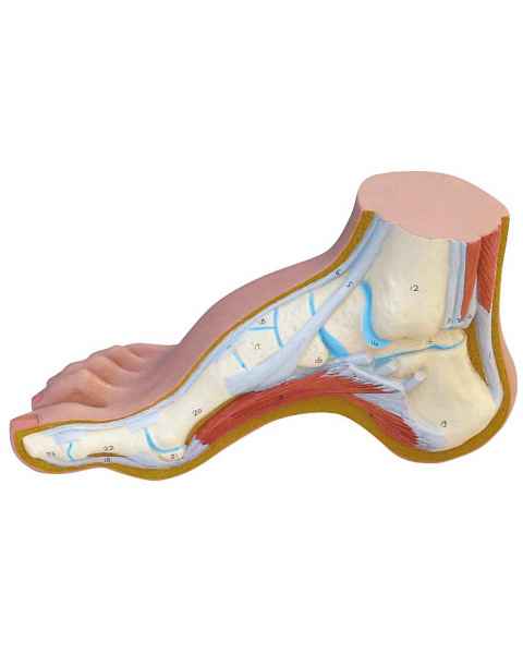 Hollow Foot Model (Pes Cavus)