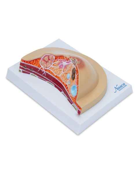 Nasco MG17229 Breast Cross-Section with Pathologies Model - Left Angle