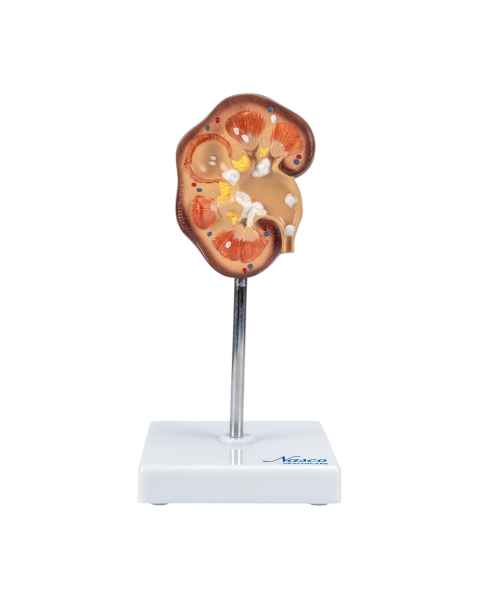 Nasco MG21415 Kidney Stone Model - Front View