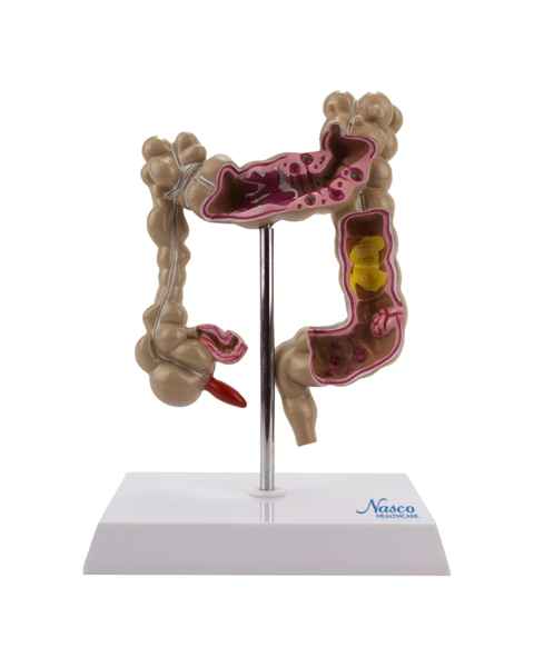 Nasco MG21850 Colon with Intestinal Pathologies Model - Front View