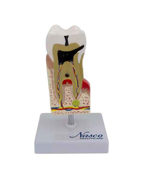 Nasco MG22727 Dental Disease Model, 10x Enlarged - Front View