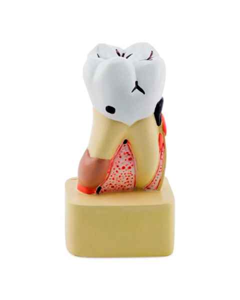 Nasco MG22728 Dental Disease Model, 4x Enlarged - Front View