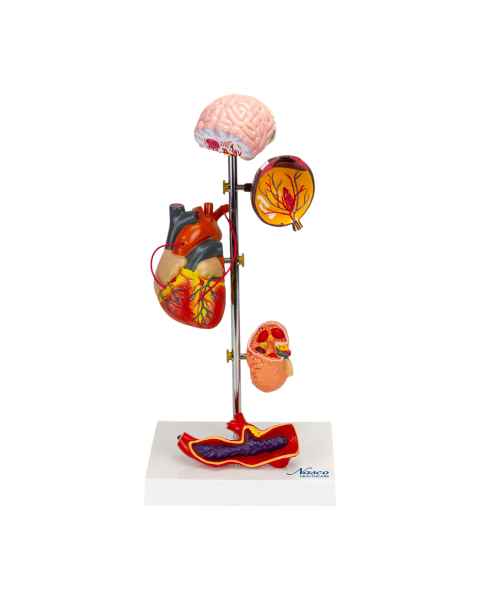 Nasco MG22747 Effects of Arterial Hypertension Pathology Model, 5-Part