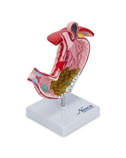 Nasco MG23162 Stomach with Gastric Ulcers Model - Right Angle
