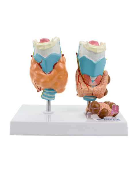 Nasco MG29725 Thyroid with Pathology Model, 4 Parts