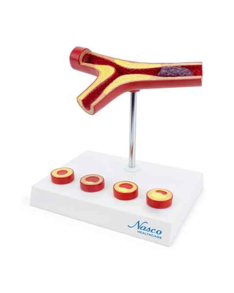 Nasco MG29729 Arteriosclerosis and Thrombosis with Artery Cross-Section Model